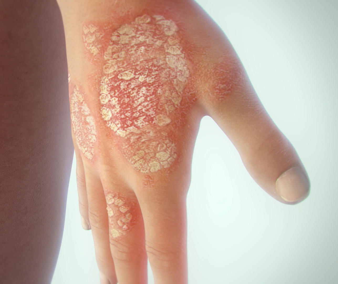 What Is The Latest Treatment For Psoriasis Arthritis