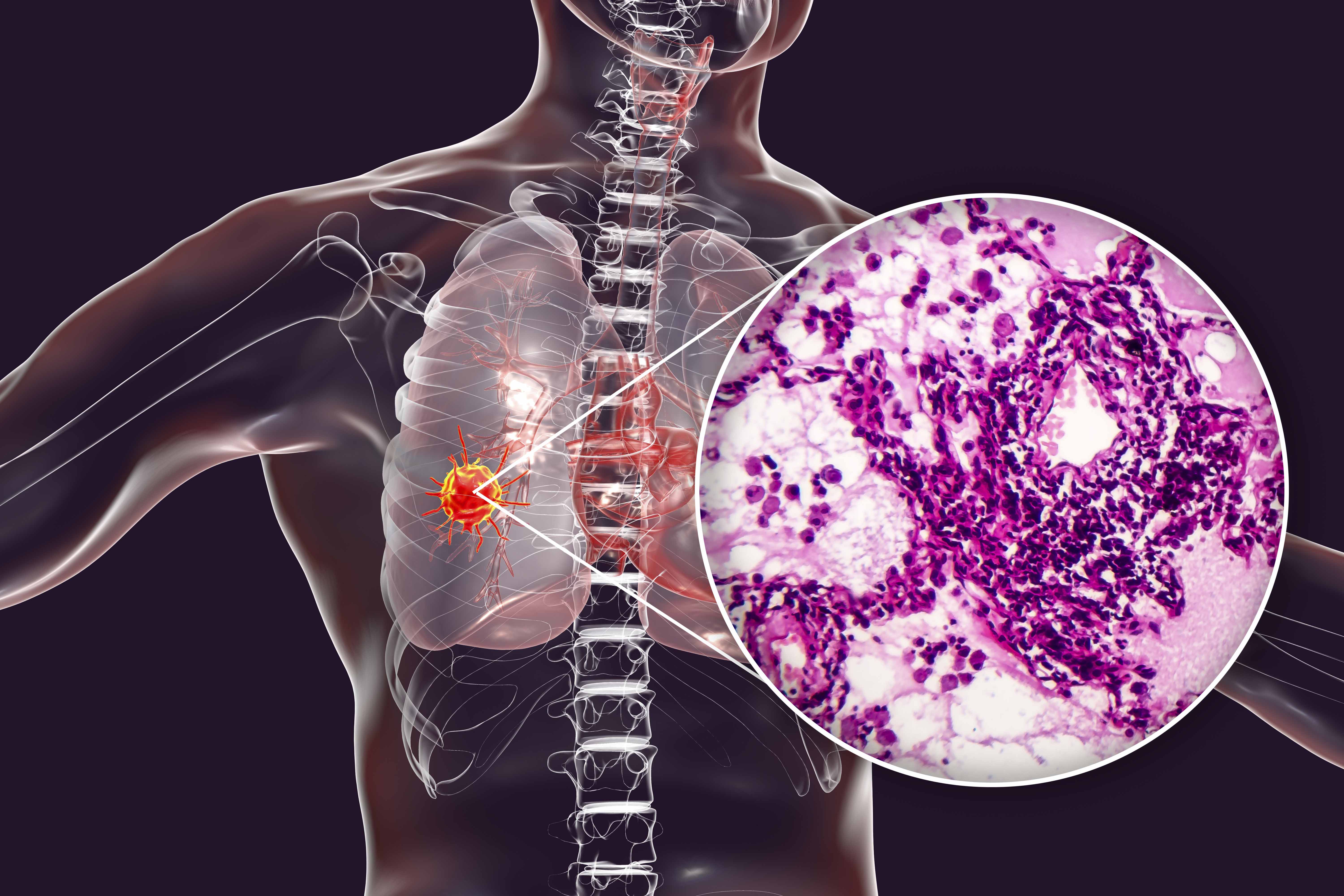 Adenocarcinoma Viva Communications