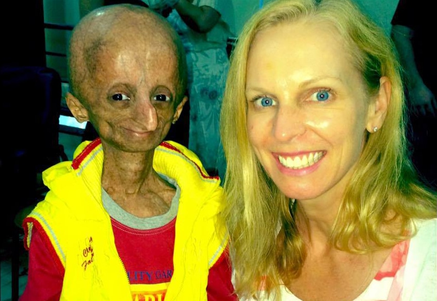 First Ever Therapy To Demonstrate Survival Benefit In Progeria