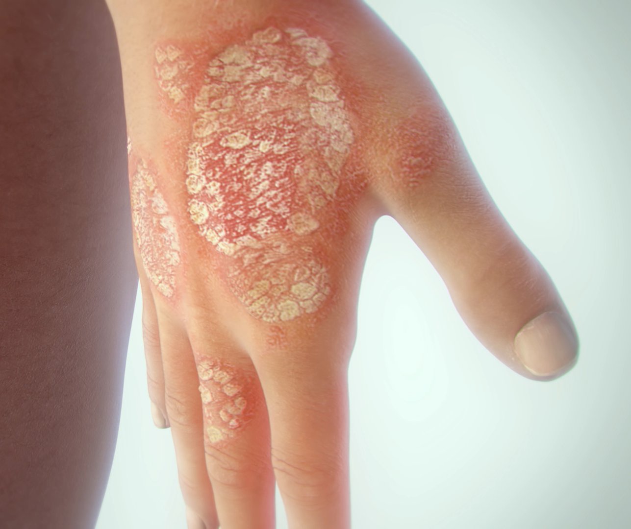 latest research on psoriasis