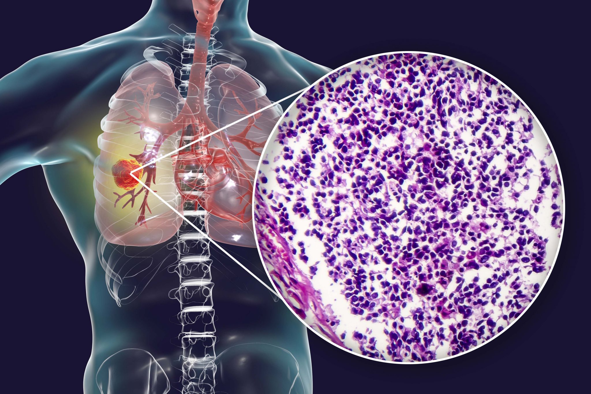 Small cell lung cancer VIVA Communications