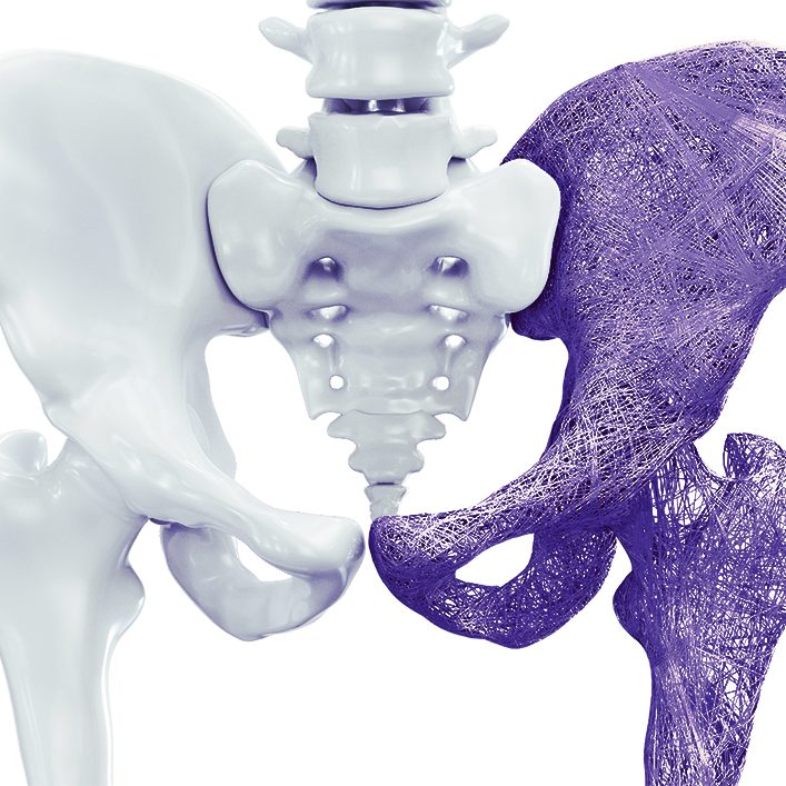 Osteoporosis upper limb bones