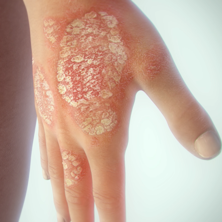 psoriasis hand